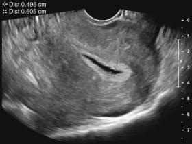 F igure 23-19, Endometrium: measurement in the setting of fluid in the endometrial cavity. Fluid in the endometrial cavity should be reported but not included in the measurement of endometrial thickness. Both layers of endometrium on either side of the fluid are included in the measurement. In the example shown, adding the endometrial measurements of 0.5 and 0.6 cm on either side of the fluid (calipers) results in a double-layer endometrial thickness of 1.1 cm.