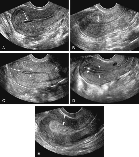 F igure 23-20, Endometrium: appearance at different stages of the menstrual cycle. Longitudinal transvaginal images of the endometrium in different patients at various phases of the menstrual cycle. A, Menstruation. A small amount of fluid in the endometrial cavity (arrow) is a normal finding during menstruation. B, Early proliferative phase. Thin, echogenic line (arrow) early in the proliferative phase, a few days after menstruation ended. C, Mid proliferative phase. The endometrium is beginning to thicken. Note the thin, hypoechoic functional layer of endometrium (arrowheads) on both sides of the central echogenic line (arrow) corresponding to the interface between endometrial tissue on either side of the uterine cavity. D, Midcycle: Late proliferative/periovulatory period. Further increase in endometrial thickness, with a multilayered appearance comprising a central echogenic line due to interface of tissue on either side of the uterine cavity, a prominent hypoechoic functional layer (arrows) on both sides of the central echogenic line, and a hyperechoic outer layer (arrowheads) corresponding to the basal layer of the endometrium. E, Secretory phase following ovulation. Further thickening of the endometrium and increased echogenicity of the previously hypoechoic functional layer, resulting in homogeneously echogenic endometrium (arrow).