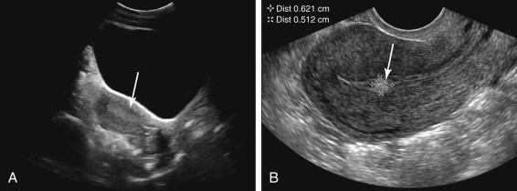 F igure 23-2, Endometrial polyp only seen on transvaginal (TV) ultrasound. A, Longitudinal midline transabdominal (TA) image of the uterus shows normal-appearing endometrium (arrow) . B, Longitudinal midline TV image of the uterus shows an endometrial polyp ( arrow and cursors ) that was too small to be identified on TA sonography.