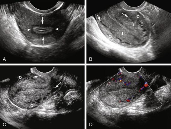 F igure 23-21, Myometrium: layers. A, Hypoechoic central layer. Axial transvaginal (TV) image of the uterus demonstrates a hypoechoic region (arrows) surrounding the endometrium. This central layer of myometrium has been termed the subendometrial halo . It corresponds to the junctional zone on MRI, and is not consistently visualized by ultrasound. B and C, Intermediate and outer layers. Longitudinal TV gray-scale images of the uterus in two different patients show arcuate blood vessels in a circumferential distribution near the periphery of the uterus (arrows) , just inside the outer margin of the myometrium. The arcuate blood vessels delineate the thick intermediate layer of the myometrium (I) from the thin outer layer of the myometrium (O). D, Longitudinal transvaginal image of the uterus with color Doppler corresponding to the image in C shows color Doppler in the arcuate vessels near the periphery of the uterus, confirming they are blood vessels.