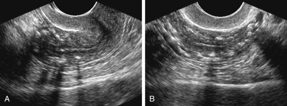 F igure 23-22, Arcuate artery calcifications. Longitudinal (A) and transverse (B) transvaginal images of a 79-year-old woman reveal multiple echogenic foci, some with posterior shadowing, in a circumferential distribution near the periphery of the uterus, corresponding to arcuate artery calcifications.