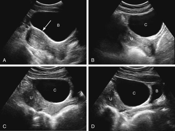 F igure 23-3, Bladder versus cystic ovarian mass. A, Longitudinal midline transabdominal (TA) image of the pelvis demonstrates pear-shaped configuration of the urinary bladder (B). Note subtle posterior impression on the bladder by the uterus (arrow) . B, Longitudinal midline TA image of the pelvis demonstrates a cystic ovarian mass (C) anterior to the uterus (U), resembling the bladder. Note the rounded shape of the cystic ovarian mass and absence of the posterior impression by the uterus seen on the image of a bladder in image A. C and D, Distinguishing a cystic ovarian mass from the bladder: importance of distending or emptying the bladder. C, Longitudinal midline TA image of the pelvis demonstrates a cystic structure (C) anterior to the uterus (U). D, Image obtained later in the examination demonstrates a small amount of urine in the bladder (B), separate from the cystic structure (C), confirming that the cystic structure is not the bladder. If there is a question as to whether a cystic structure in the pelvis is the urinary bladder, the identity of the bladder can be confirmed by emptying or filling it. U, Uterus.