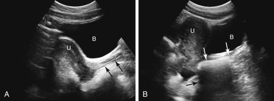 F igure 23-4, Vagina. A, Normal appearance. Longitudinal midline transabdominal (TA) image of the pelvis depicts the vagina (black arrows) as a hyperechoic line surrounded by hypoechoic tissue posterior to the urinary bladder. B, Tampon. Longitudinal TA image of the pelvis shows a linear echogenic structure (white arrows) in the expected location and orientation of the vagina, corresponding to a tampon in the vagina. Note the prominent dirty shadowing deep to the tampon (black arrow) due to air in the tampon. B, Bladder; U, uterus.