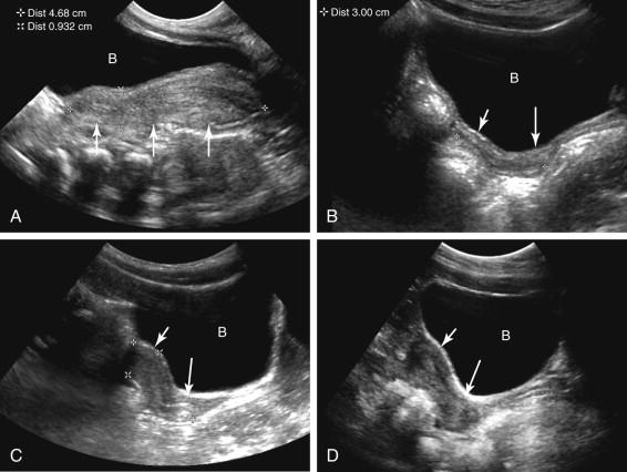 F igure 23-5, Uterine size and configuration: neonate to teenager. Longitudinal transabdominal images of the uterus in different patients at increasing ages. A, Neonate: the uterus (arrows) is prominent due to the effects of maternal hormones. B, Prepubertal years. Elongated tubular configuration of the uterus in a 4-year-old girl. The uterus is small and the uterine body (short arrow) is similar in size to the cervix (long arrow) . C, Changes in the uterus as menarche approaches. Note enlargement and increase in prominence of the uterine body (short arrow) relative to the cervix (long arrow) in an 8-year-old girl. D, Adult configuration of the uterus several years following the onset of menses. The uterine body (short arrow) is more prominent than the cervix (long arrow) in a nulliparous 15-year-old girl. B , Bladder.