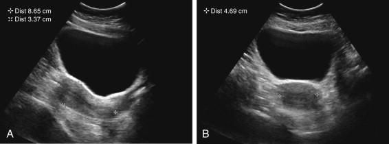 F igure 23-6, Uterus: measurement. A, Sagittal transabdominal (TA) image demonstrates measurement of uterine length from top of the fundus to bottom of the cervix in the region of the external cervical os (+ cursors) and measurement of anteroposterior diameter perpendicular to the length measurement (x cursors) . B , Transverse TA image demonstrates measurement of uterine width (+ cursors).