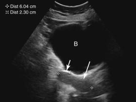 F igure 23-7, Postmenopausal uterus. Longitudinal transabdominal image demonstrates small size of the uterus in a 72-year-old postmenopausal woman. Note the relatively small size of the uterine body (short arrow) . Long arrow, cervix. B, Bladder.