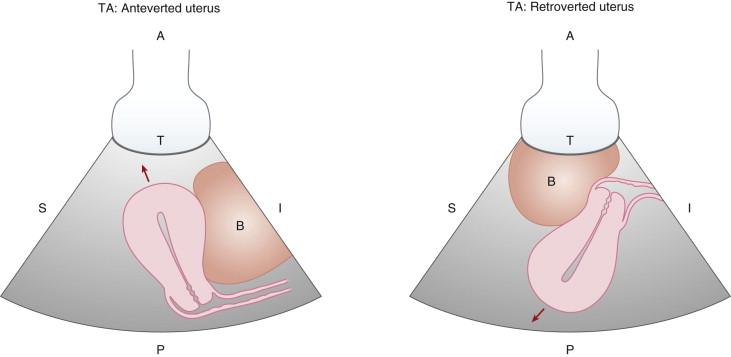 F igure 23-8, Transabdominal (TA) uterine orientation. Schematic representation of an anteverted and a retroverted uterus in the sagittal scan plane at TA ultrasound. The left diagram shows that the fundus of the anteverted uterus is directed anteriorly (red arrow) toward the transducer, and the right diagram shows the fundus of the retroverted uterus is directed posteriorly (red arrow) away from the transducer. A, Anterior; B, bladder; I, inferior; P, posterior; S, superior; T, transducer.