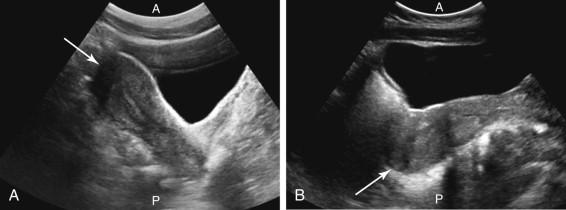 F igure 23-9, Transabdominal longitudinal ultrasound images of an anteverted (image A ) and a retroverted (image B ) uterus, similar to diagrams in Fig. 23-8 , demonstrate the fundus (arrow) of the anteverted uterus directed anteriorly, and the fundus (arrow) of the retroverted uterus directed posteriorly. A, Anterior; P, posterior.