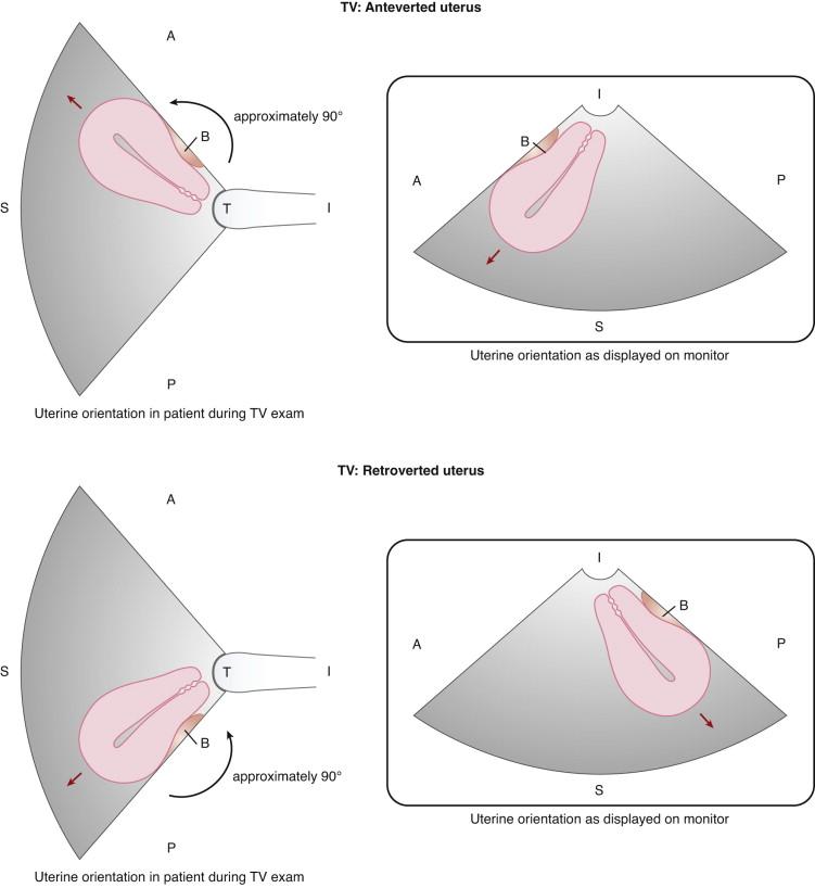 F igure 23-10, Transvaginal (TV) uterine orientation. Schematic representations of an anteverted (top diagrams) and a retroverted (bottom diagrams) uterus in the sagittal scan plane at TV ultrasound. Diagrams on the left side show anatomic orientation of the uterus and transducer in a patient in supine position during a TV examination. Diagrams on the right side depict the uterus as it is displayed on the image on the monitor. Because the portion of the image closest to the transducer is depicted at the top of the image by convention, the TV field of view is rotated approximately 90 degrees counterclockwise in the image displayed on the monitor. Consequently the fundus of an anteverted uterus is directed toward the left side of the image displayed on the monitor (top right image, red arrow), and the fundus of a retroverted uterus is directed toward the right side of the image displayed on the monitor (bottom right image, red arrow). A, Anterior; B, bladder; I, inferior; P, posterior; S, superior; T, transducer.