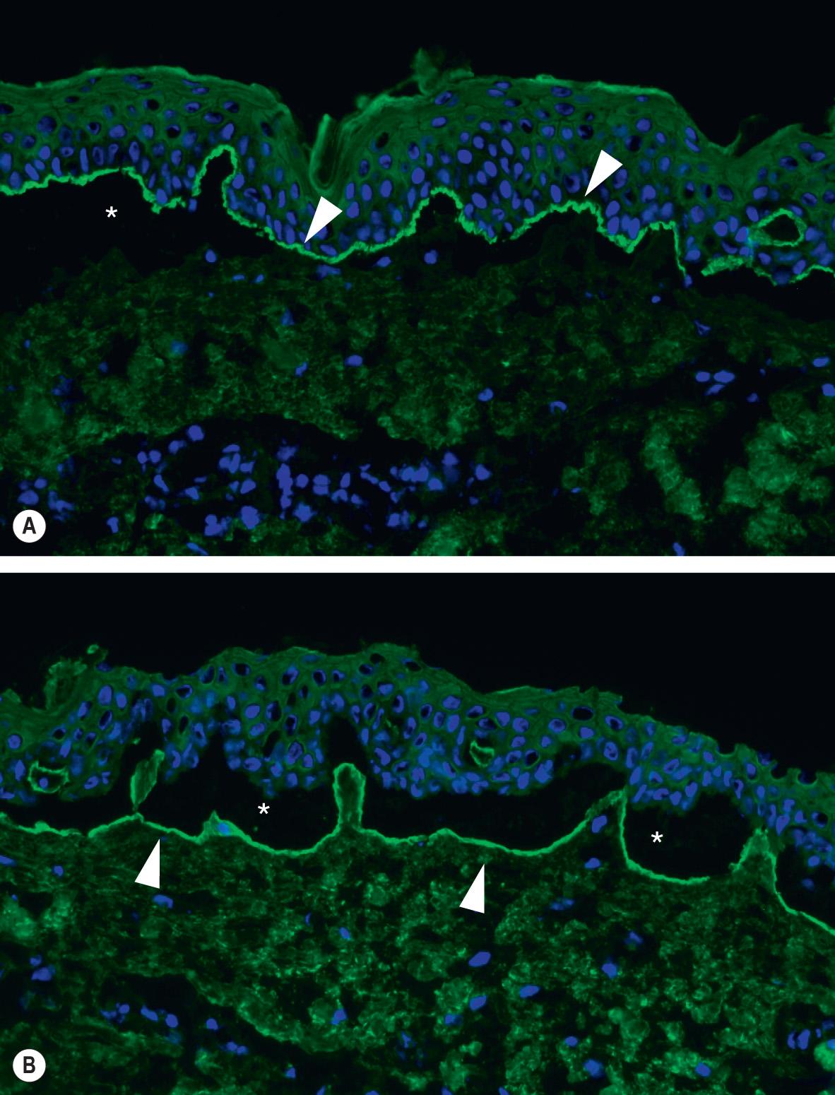 Fig. 30.11, Indirect immunofluorescence (IIF) microscopy utilizing salt-split human skin.