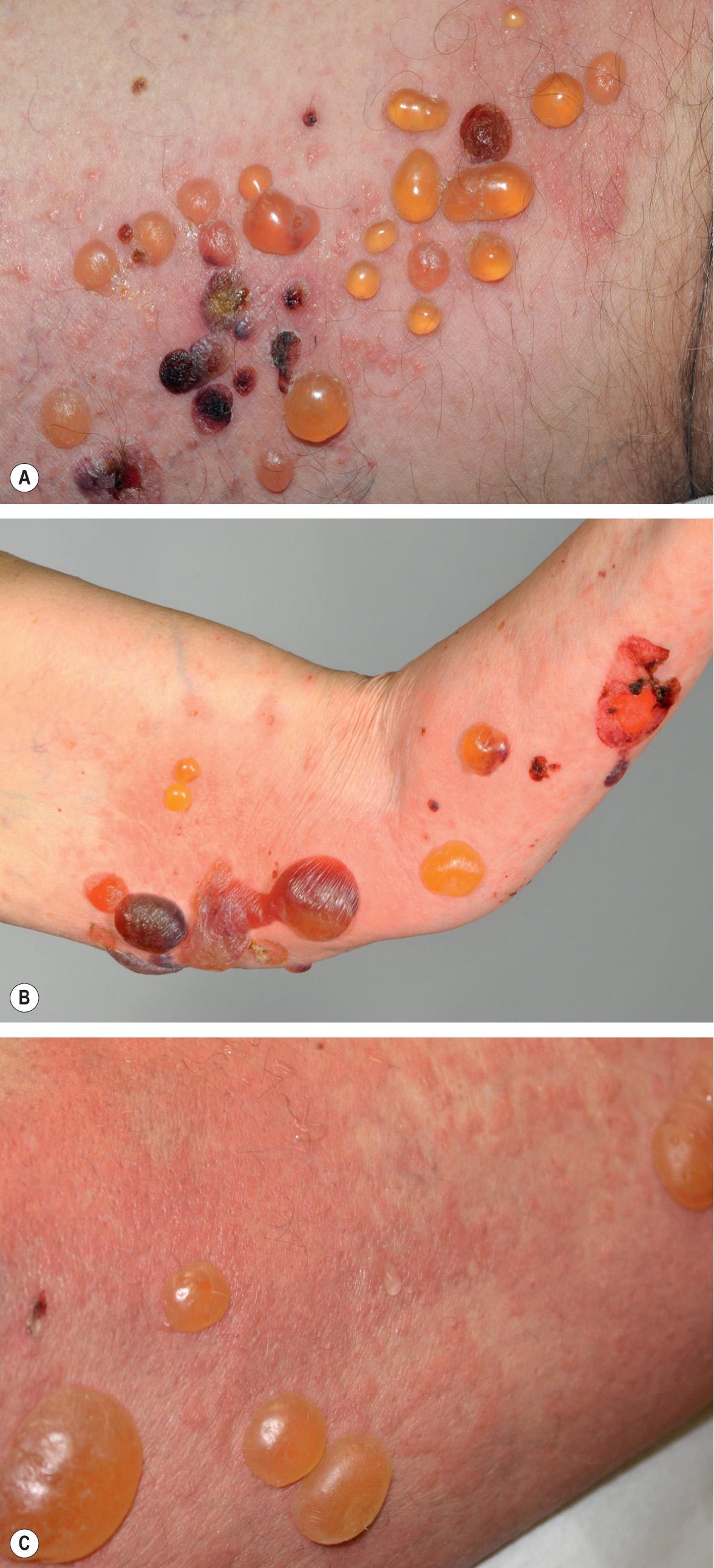 Fig. 30.2, Bullous pemphigoid – classic presentation.