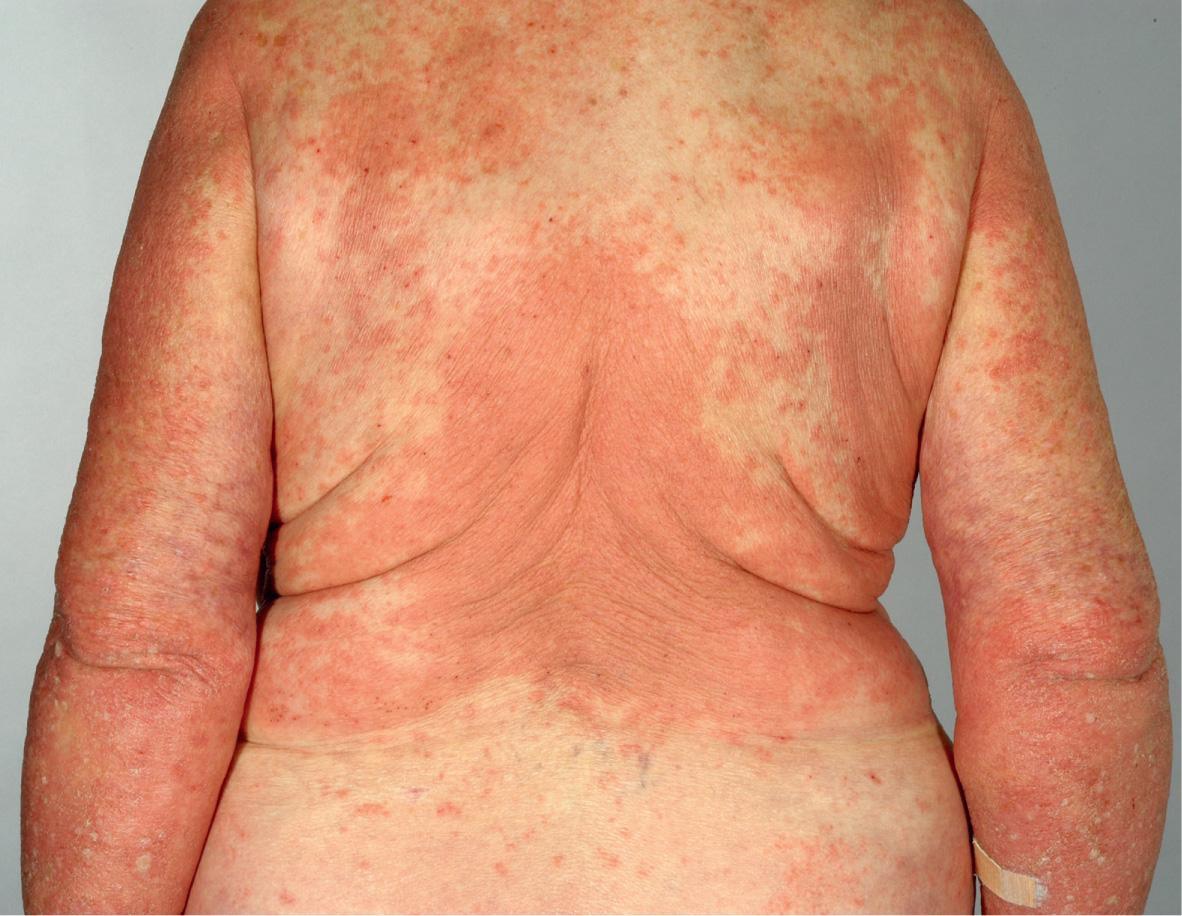 Fig. 30.4, Bullous pemphigoid – eczematous presentation.