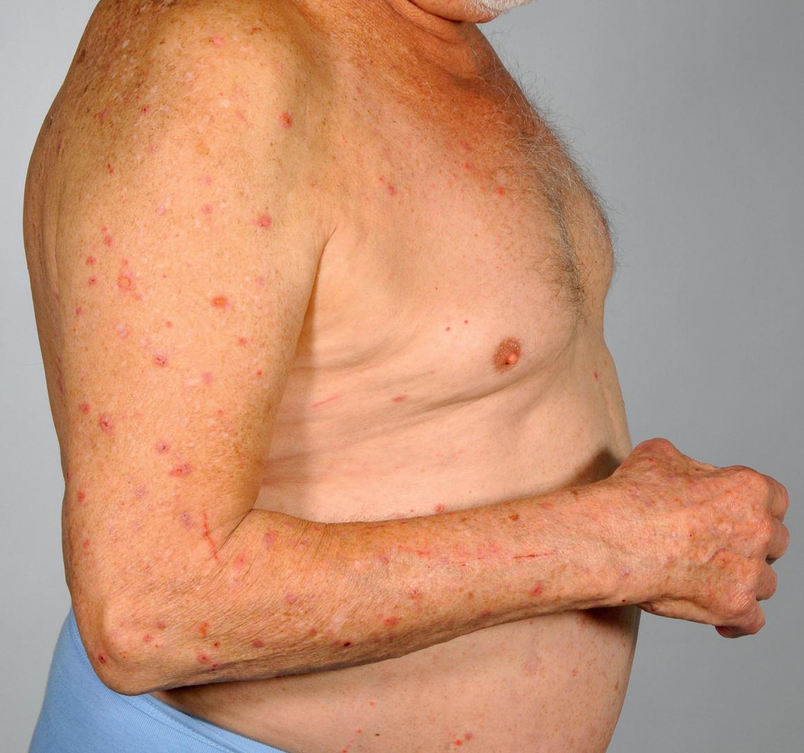 Fig. 30.5, Bullous pemphigoid – nonspecific lesions due to pruritus.