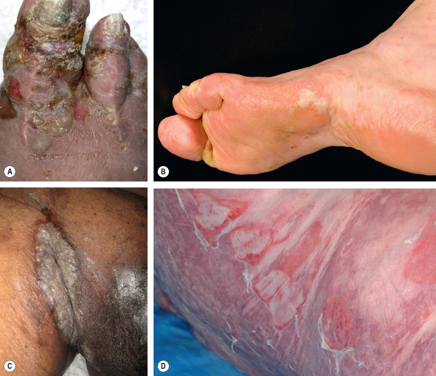 Fig. 30.6, Bullous pemphigoid – uncommon clinical variants.