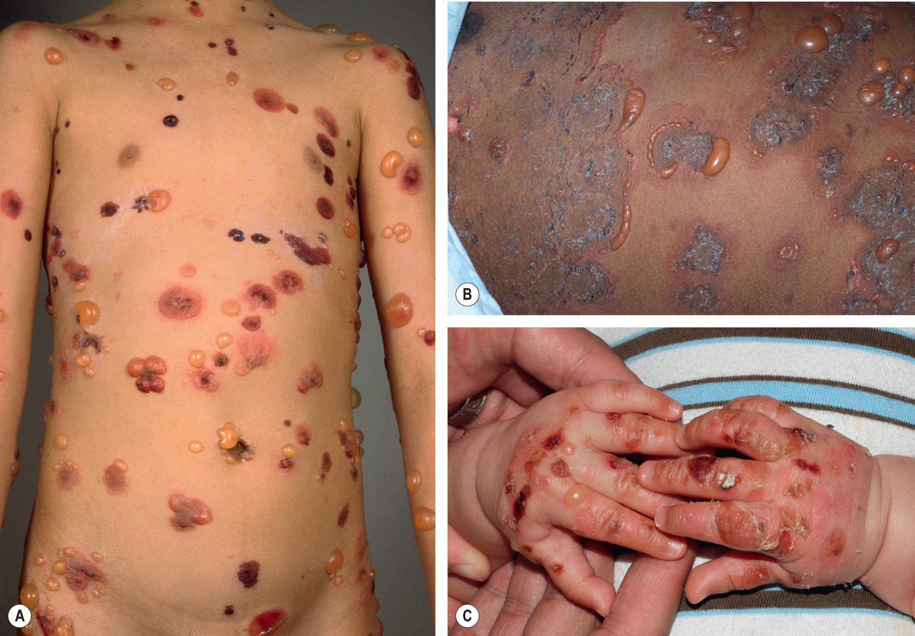 Fig. 30.7, Childhood bullous pemphigoid.