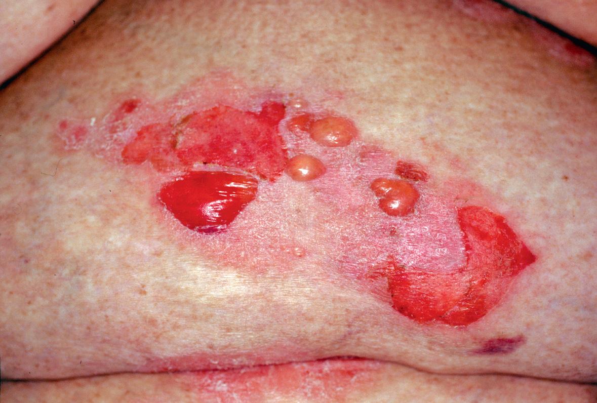 Fig. 30.8, Bullous pemphigoid localized to a psoriatic plaque.