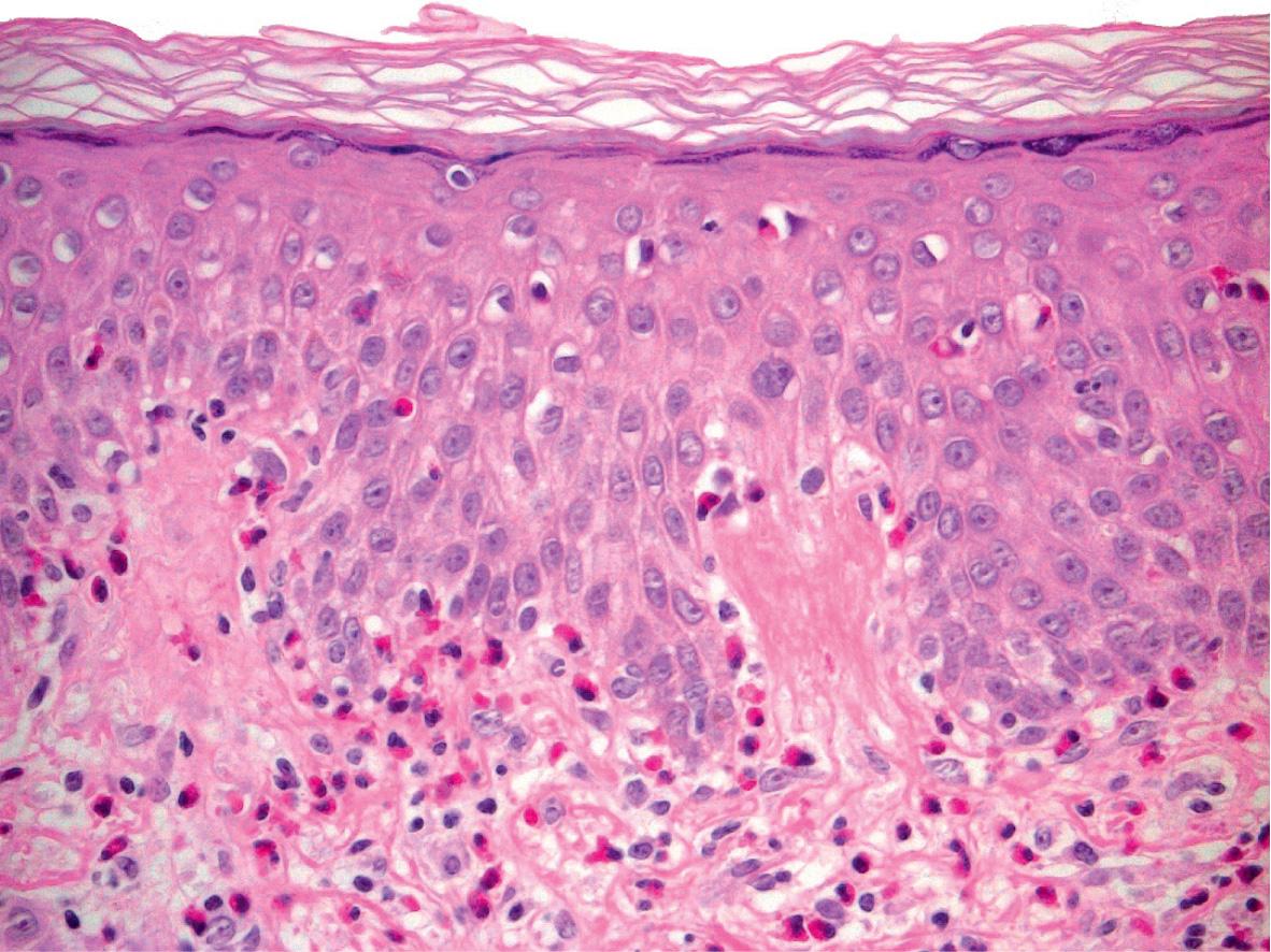 Fig. 30.9, Urticarial phase of bullous pemphigoid – histologic features.
