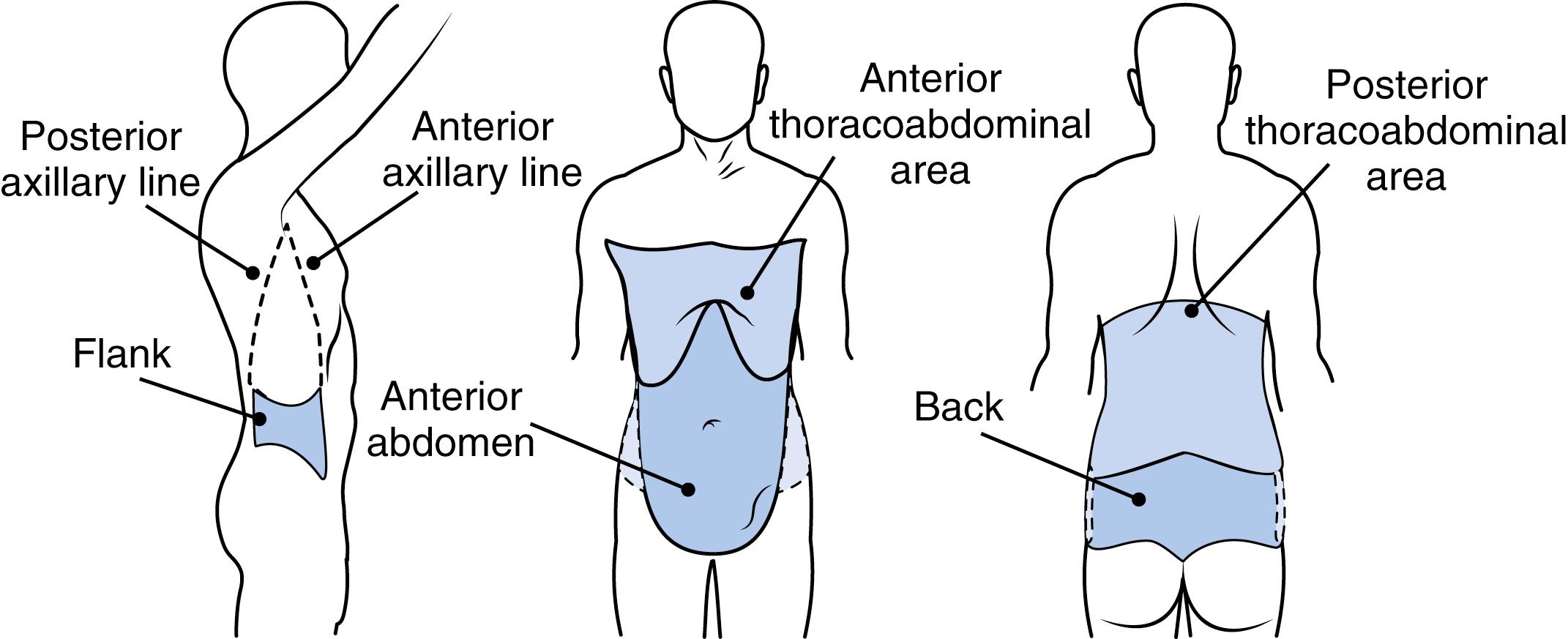 Fig. 25.2, An example of how the path of a bullet through a contorted body can produce confusion when the patient is examined in the ED. An entrance wound will be found at the left upper arm and an exit wound at the medial aspect of the right knee. The bullet could have damaged any structure between these two wounds when the patient’s body was contorted.