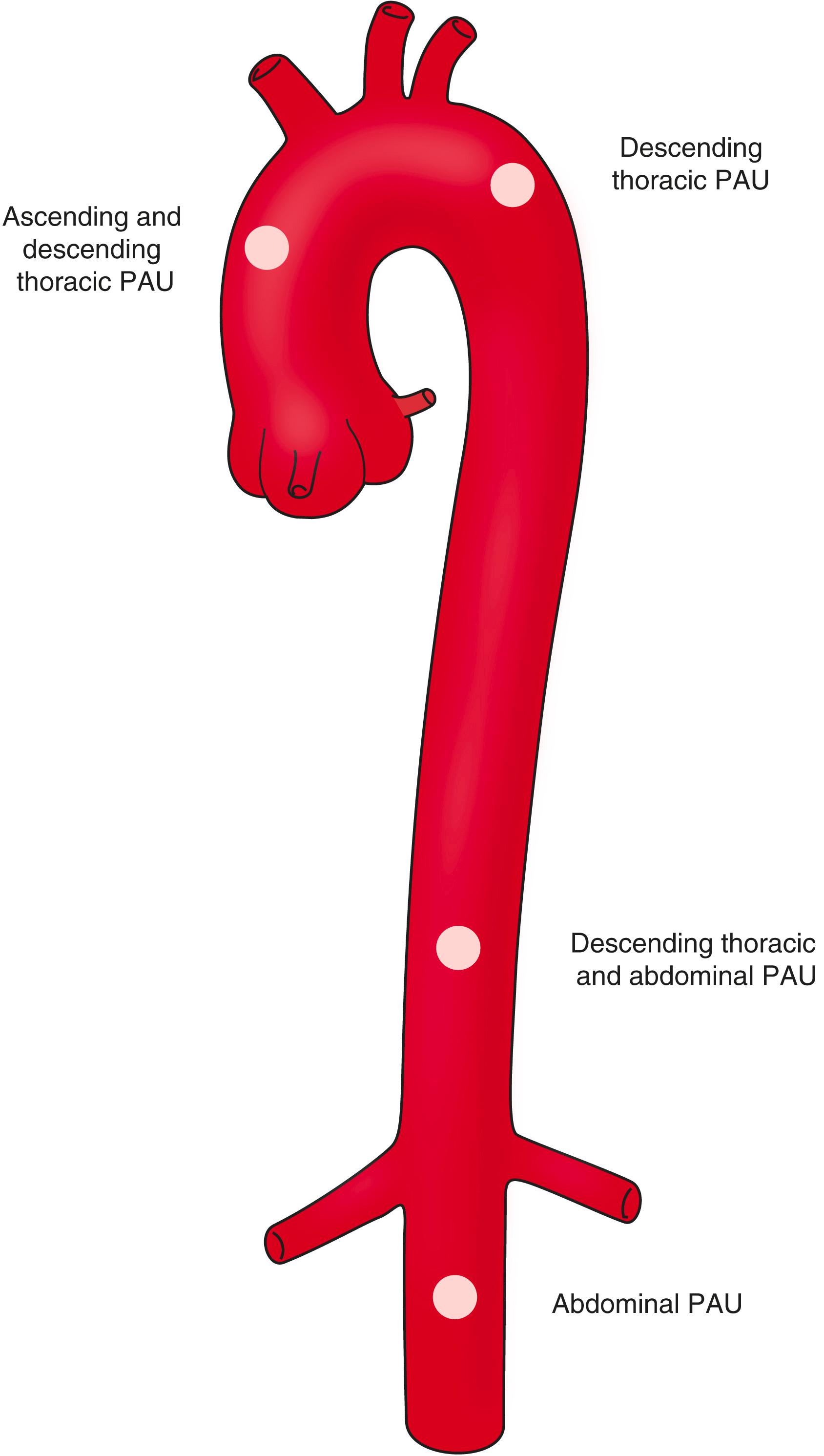 Figure 84.1, Distribution of Penetrating Aortic Ulcer (PAU) Along the Aorta and Associated Common Symptoms.