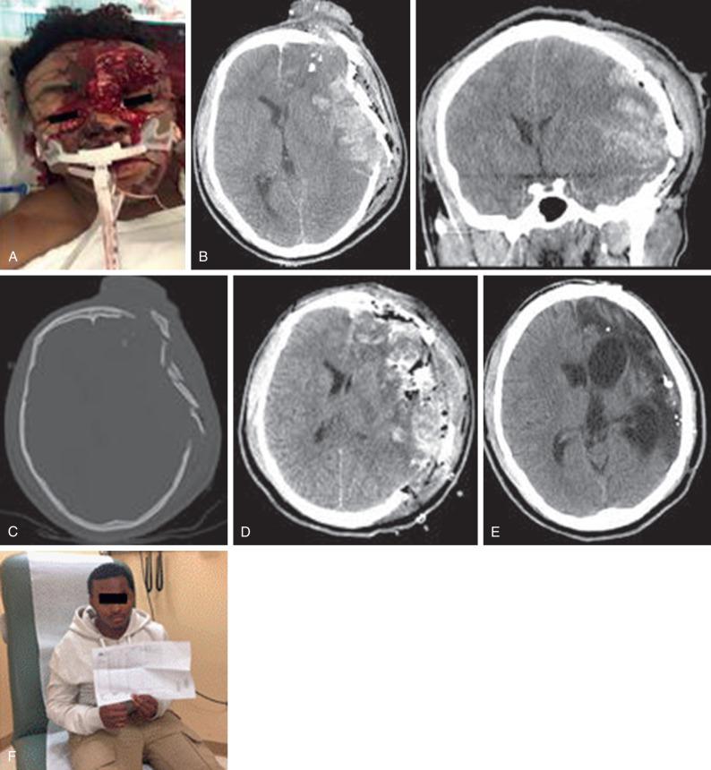 Figure 27.1, (A) Initial presentation showing extensive external left frontal injury from the exit wound site. (B) Axial and coronal noncontrast head CT demonstrating a left unihemispheric, tangential trajectory through the left frontal-parietal cortex and Sylvian fissure. Left to right midline shift is also appreciated. Entrance wound was high left parietal with a left frontal exit wound just above the frontal sinus. (C) Axial CT bone window showing the comminuted left frontal-parietal bony destruction. The patient also had fractures of the left orbital roof and frontal root of the zygoma. (D) Post-op imaging from a left decompressive hemicraniectomy. (E) The patient was brought back several months later for his cranioplasty. Left frontal-parietal encephalomalacia with ex-vacuo of the left frontal and occipital horns are seen. (F) The patient with his most recent high school report card.