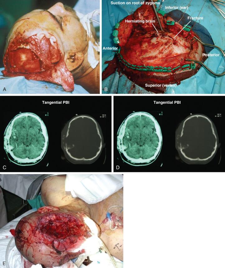 Figure 27.2, (A) Tangential penetrating injury with posterior entry. (B) Patient was immediately taken for decompressive hemicraniectomy for elevated intracranial pressures. (C–D) Axial noncontrast computed tomography (CT) scan demonstrating superficial scalp hematoma, with comminuted bony fracture and underlying hemorrhagic contusion. No midline shift, preservation of the basal cistern, without a focal mass lesion. (E–F) Severe lateral temporofacial explosive blast injury with significant disruption of anatomic continuity, tissue loss, associated traumatic orbital injury, with left hemispheric edema, midline shift, obliteration of ambient cisterns, and focal temporal lobe hematoma. Patient responded well to left hemicraniectomy, evacuation of temporal lobe hematoma, left orbital enucleation, and staged skull base repair. Incision was placed in midline with large left posterior auricular curve toward the mastoid tip away from the zone of injury. After hemicraniectomy, duraplasty, skull base repair with split-thickness bone graft from the cranial plate of the hemicraniectomy, with tissue closed up to the zygoma separating the lateral facial component, followed by initial wound packing in the infratemporal portion, wound was later definitively closed after subsequent débridements.