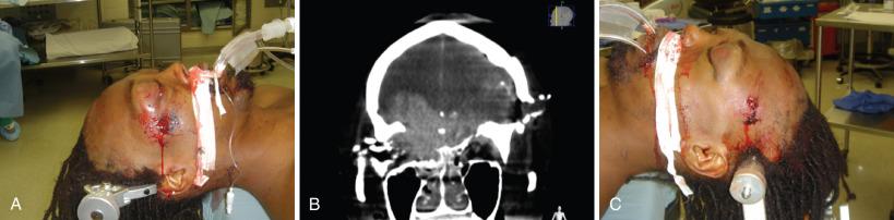 Figure 27.3, (A) Victim of a point blank attempted homicide evidenced by powder burns at the entry site. At the initial physical examination, this bihemispheric gunshot wound to the head (A–B) appears to cross the zona fatalis, but the computed tomography (CT) scan (C) instead reveals a more anterior trajectory. This information led to the appropriate course of decompression and aggressive management, subsequently resulting in a favorable outcome.