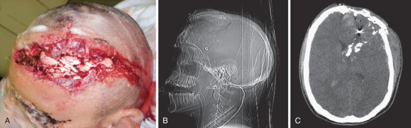 Figure 27.5, (A–C) Severe penetrating brain injury caused by pistoning of the patient's Kevlar helmet upon impact of a nonpenetrating high-velocity round. These “under the body armor” wounds share a similar mechanism and pattern as Cushing's “guttering” injuries, but they may be from a variety of orientation angles at impact.