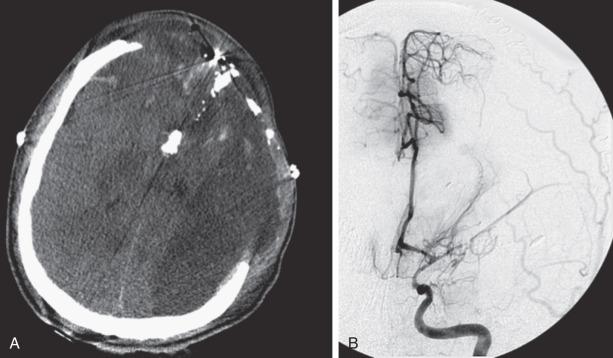 Figure 27.6, (A–B) Computed tomography (CT) scan of the pilot in Fig. 21.11 reveals the degree of bone fragmentation resulting in a secondary projectile phenomenon. Bony fragments drove into the depths of the sylvian fissure, resulting in stenosis and occlusion of the middle cerebral artery major divisions and a large hemispheric infarct.