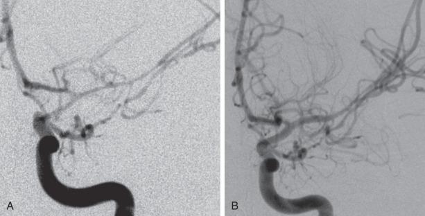 Figure 27.7, Posttraumatic vasospasm in penetrating brain injury before (A) and after (B) being treated successfully with intraarterial nicardipine and angioplasty. Vasospasm was picked up on serial transcranial Doppler (TCD) examination when velocities in the M1 and M2 branches exceeded 250 and Lindegaard ratios became greater than 5. The patient had a poor neurologic examination and already had scattered areas of ischemic infarct on computed tomography (CT) scan; therefore intervention was felt to be warranted. Posttreatment velocities fell to just over 100, and the Lindegaard ratio dropped to less than 3.