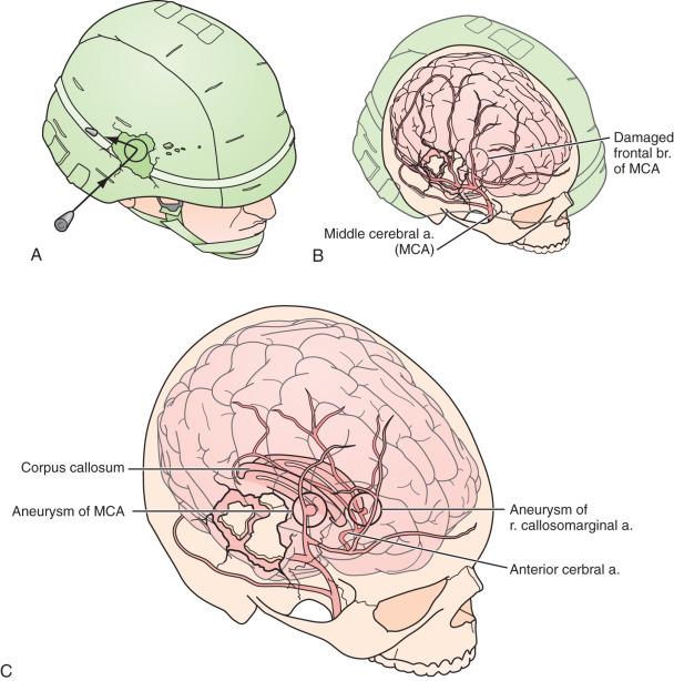 Figure 27.9, Artist's rendition of an “under the body armor” injury. (A) Point of contact with subsequent pistoning of the inner helmet table. (B) In-driven bone fragments with vessel laceration. (C) Pseudoaneurysm formation.