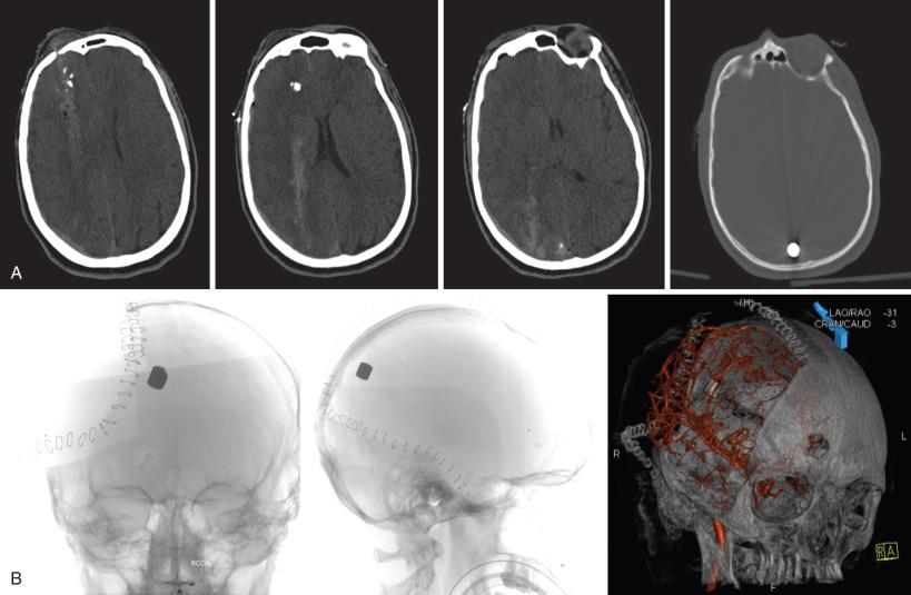 Figure 27.10, (A) Soldier with right frontal entry wound and complete anteroposterior penetration through the right hemisphere. Subsequent ricochet placed the projectile just lateral to the posterior sagittal sinus. Immediate decompression resulted in a postresuscitation Glasgow Coma Scale (GCS) score of 11 with improvement to 15 after extubation. Angiogram revealed no vascular injury; plain skull radiographs and postangiography volumetric reconstruction are shown (B).