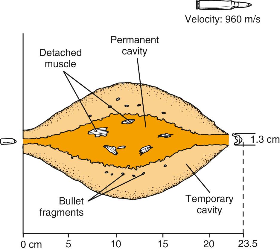 Fig. 120.1, Characteristic wound profile of a high-velocity, soft point rifle bullet.