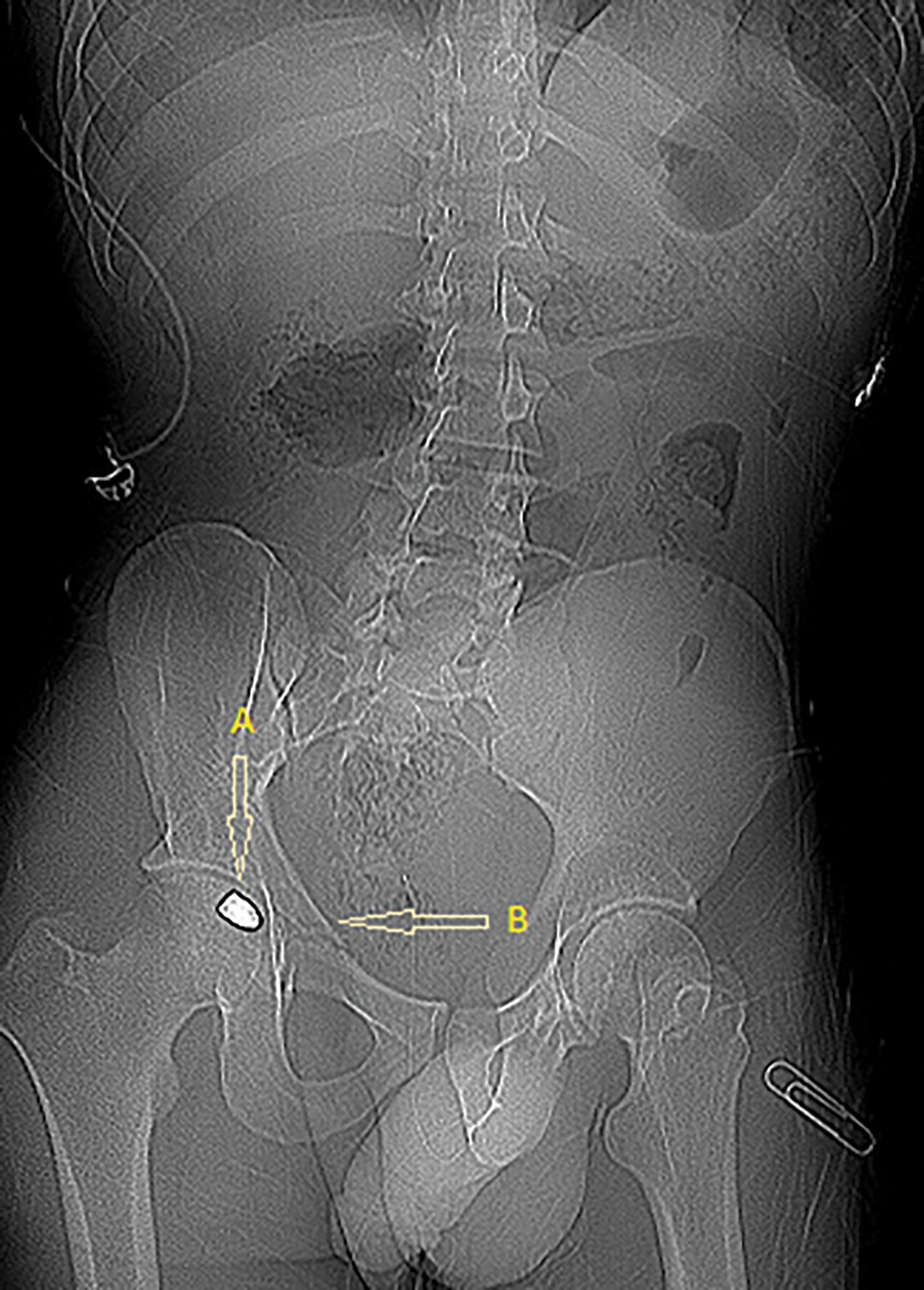 FIGURE 1, Transpelvic gunshot wound. Entrance was located in the left lateral thigh, creating a common femoral arteriovenous fistula, which was identified by clinical examination. Abdominal scout with projectile (arrow A) in the femoral head and pelvic fracture (arrow B) from transpelvic gunshot wound.