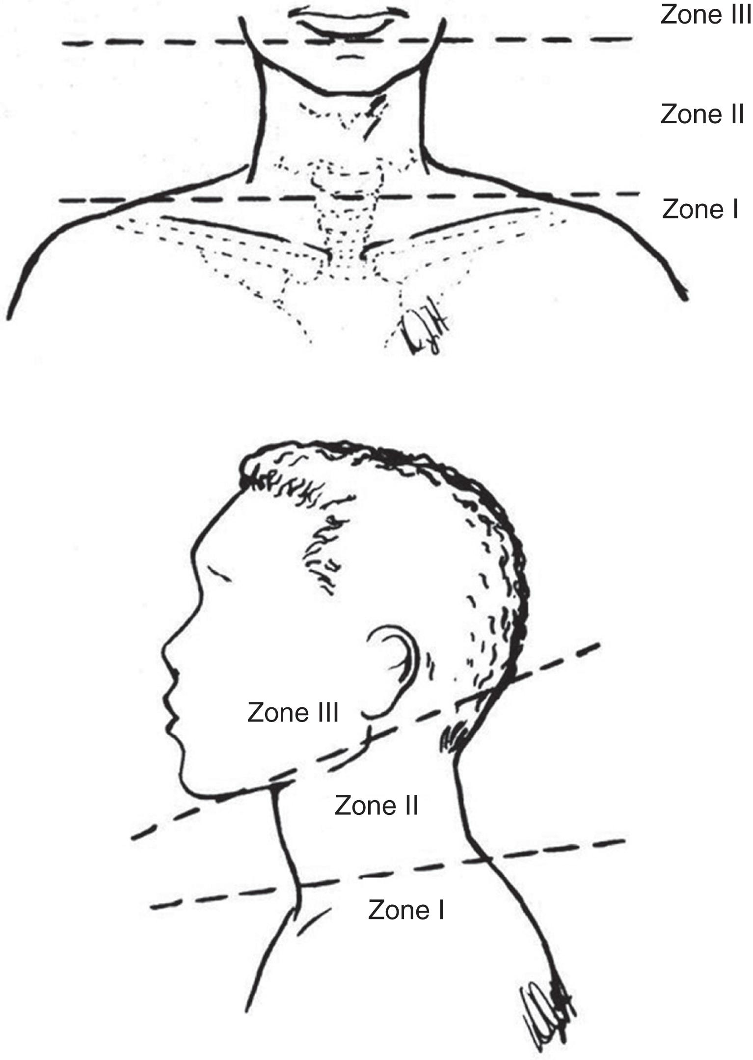 FIGURE 1, Zones of the neck for injury stratification. (Drawing by Doris Holloman.)