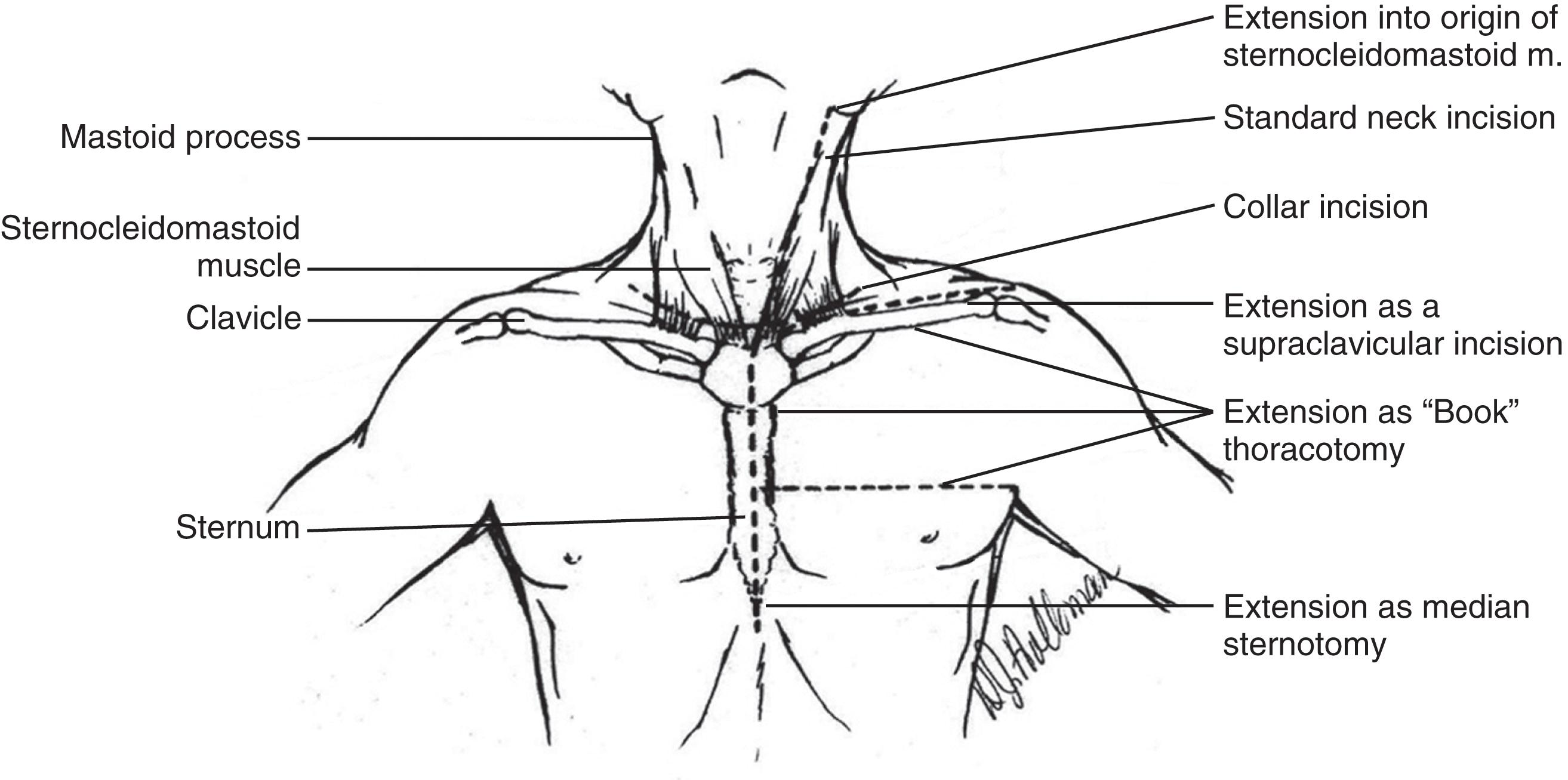 FIGURE 2, Incisions for operative exposure of penetrating neck injuries. (Drawing by Doris Holloman.)