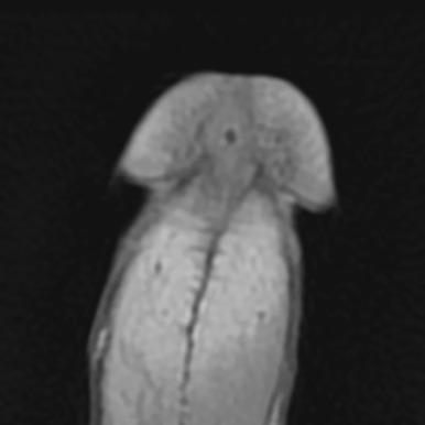 Fig. 65.1, Magnetic resonance imaging (MRI) of the penis. The erectile bodies are normally bright white on MRI. This image shows dark tumor centrally involving the glans.