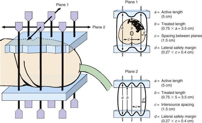 eFig. 65.1, Schematic of Paris system of dosimetry for two-plane interstitial implants. Dimensions of treatment isodose can be predicted from length and spacing of radioactive sources.