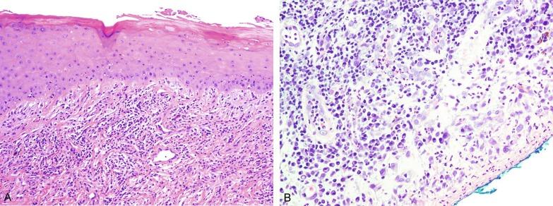 Fig. 15.13, (A) Zoon balanitis with reactive epithelial changes in the epidermis and a dermal inflammatory infiltrate accompanied by edema (low power). (B) Zoon balanitis with abundant plasma cells in the inflammatory infiltrate (high power).