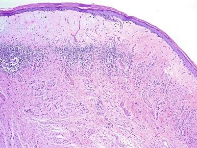 Fig. 15.15, Balanitis xerotica obliterans (lichen sclerosus) showing homogeneous collagen in upper dermis with a band of chronic inflammation just below.