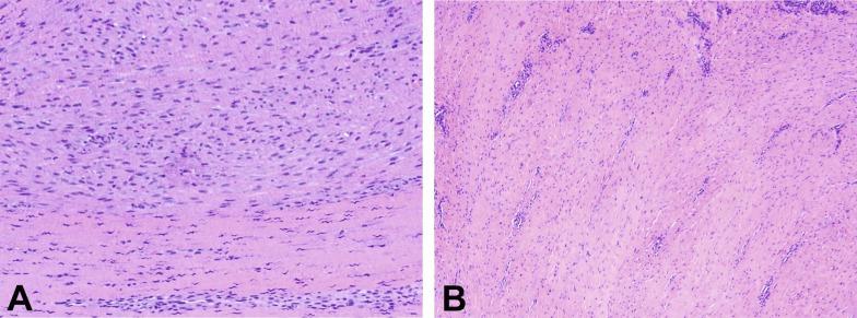 Fig. 15.17, (A) Peyronie disease, cellular region. (B) Peyronie disease, densely collagenous region.