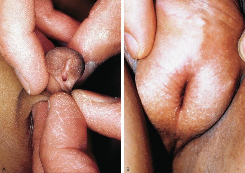 Fig. 15.4, (A) Distal hypospadias with the urethral meatus at the junction of the glans and penile shaft. (B) Proximal hypospadias with the urethral meatus at the base of the scrotum.