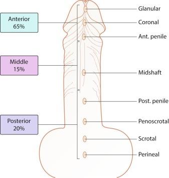 Fig. 15.6, Location of hypospadias.