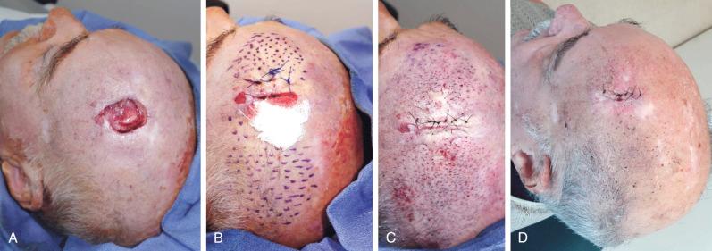 Figure 7.2, Scalp defect closed with PALF instead of a flap. (A) 4 × 5 cm scalp defect surrounded by scars from previous cancer excisions. (B) Wound edges approximated under extreme tension with retention sutures over bolster. (C) Percutaneously meshing 8 cm on both sides of the defect led to a tensionless closure with 5-0 nylon. (D) Uneventful healing 1 week postoperatively.