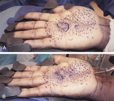 Figure 7.3, (A,B) Palmar wound closed with PALF tissue regeneration instead of flap. Mesh expansion of the native palmar aponeurosis allowed tensionless closure with 5-0 nylon stitches. Lipofilling the gaps in the mesh pattern prevented recurrence of the tightness and helped regenerate the needed tissue. This is the principle of the recently described modification of the Dupuytren release technique. 2