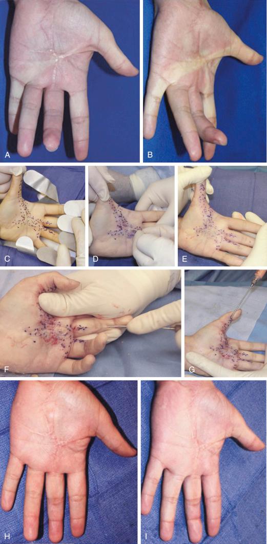 Figure 7.4, Mid-palmar stellate contracture of the hand treated with PALF. Gunshot blast injury allowed to heal by secondary intension. Despite months of splinting and therapy, the patient has a mid-palmar stellate scar contracture and tendon adhesions that restricted digital extension (A,B). The deficiency was treated with a PALF similar to a Dupuytren contracture release. 2 With the contracture under tension, the restrictive scar was mesh-expanded through multiple punctures and the resultant loosened structure was grafted with 30 mL of dilute lipoaspirate, diffusely injected into the palm (C–G). The hand was splinted in extension for 1 week and then with night splints for 3 months. Results 6 months postoperatively are shown (H,I). 1