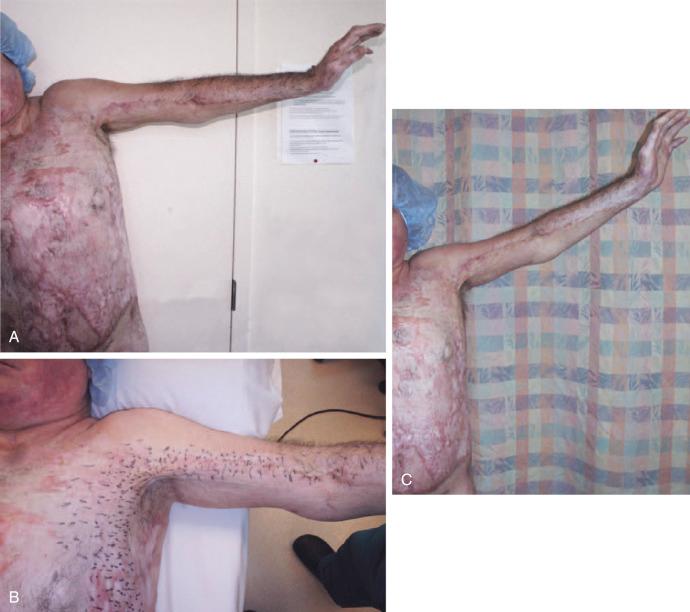 Figure 7.5, Axillary contracture treated with PALF. A 42-year-old male with second- and third-degree burns to the trunk, axilla, and left upper extremity treated with skin grafts. Despite therapy and extension splints, he presented 1 year later with a severe axillary contracture (A). After tumescent lipofilling of the burn scar with 150 mL of dilute lipoaspirate, and with the contracture maintained under tension by extending and abducting the shoulder, a percutaneous aponeurotomy of the restrictive scar was performed through hundreds of staggered skin nicks over a wide area. To preserve the integrity of the scar and its ability to support fat grafts, the concentration of nicks in the axilla was limited. Tissue length needed for arm elevation was gained by performing the PALF over an area extending from the antecubital fossa to the abdomen (B). At 3 months follow-up, a 45° abduction gain was achieved, and the scar was significantly softened (C).