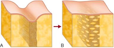 Figure 7.6, (A,B) A scar is like a restrictive solid brick wall tethering down the tissues and separating two fatty compartments. Rigottomies and “Jackhammer grafting” can mesh-expand the brick wall, loosen the scar, and create openings or microcavities where the graft can lodge and survive. The cicatrix becomes a matrix for fat grafting. The result is a scar that is less restrictive, less brick-like, and closer to normal fat. Repeating the process can altogether eliminate the scar.