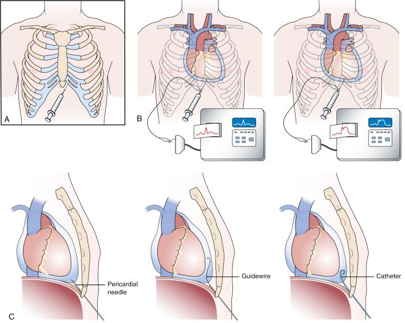 Fig. 59.1, (A) Diagrammatic representation of a pericardiocentesis procedure using the subxiphoid approach. (B) The pericardial needle is connected to an electrocardiographic (ECG) lead. The needle is advanced from the left of the subxiphoid area, aiming toward the left shoulder. ST-segment elevation is seen on the ECG lead tracing when the needle touches the epicardium. The needle should be retracted slightly until the ST-segment elevation disappears. (C) After the pericardial space has been entered with the pericardial needle, a guidewire is introduced in the pericardial space through the needle. The needle is removed, and a catheter is inserted over the guidewire anteriorly or inferiorly into the pericardial sac.
