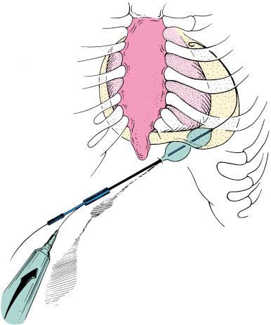 Fig. 59.2, Percutaneous balloon pericardiotomy technique.