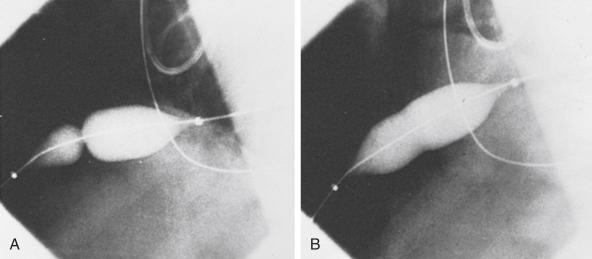 Fig. 59.5, Lateral fluoroscopic image of balloon inflation.